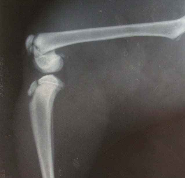 рентгенограмма  перелома  бедра